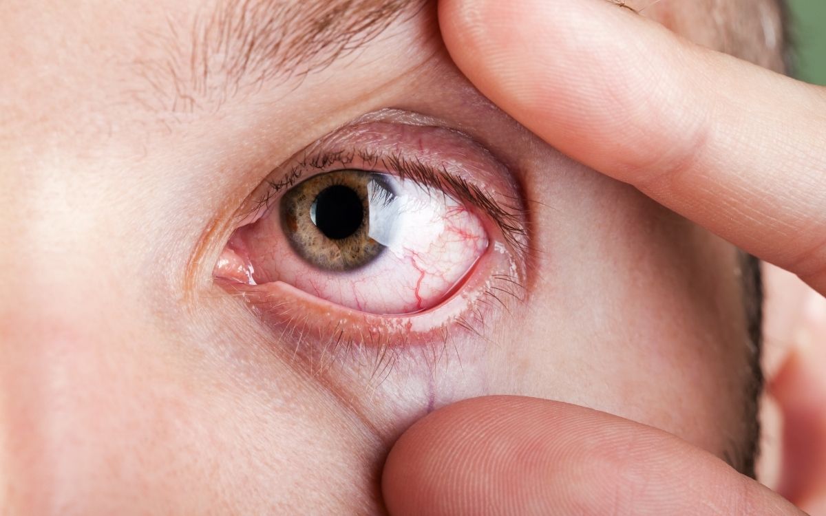 ojo seco.jpg Ojo seco optisalud