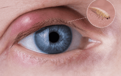 Demodex en las pestañas: el ácaro microscópico que puede afectar la salud de tus ojos